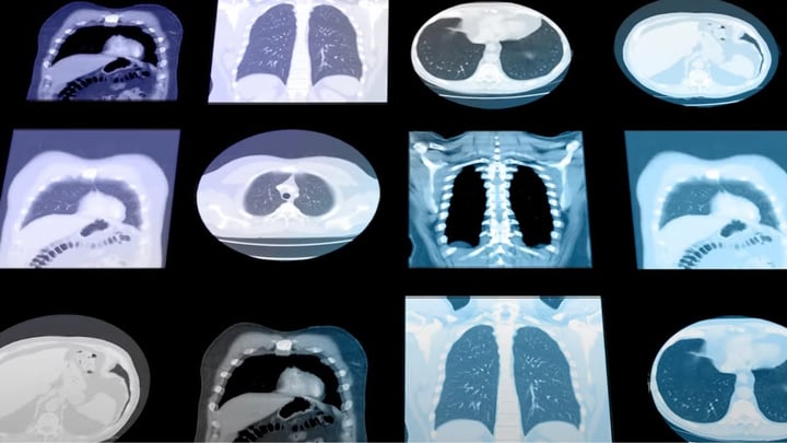 Sybil: An AI model that can predict lung cancer risk 6 years in advance